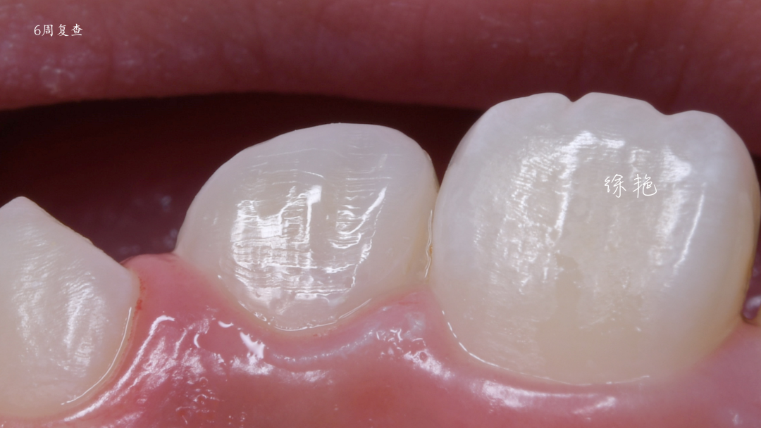 示范牙医·徐艳｜上前牙釉质矿化不全伴深龋树脂修复一例